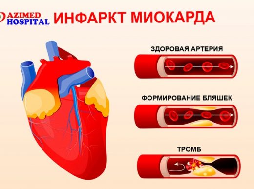 Инфаркт миокарда