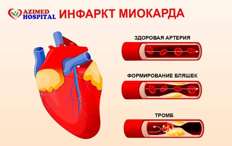 Инфаркт миокарда